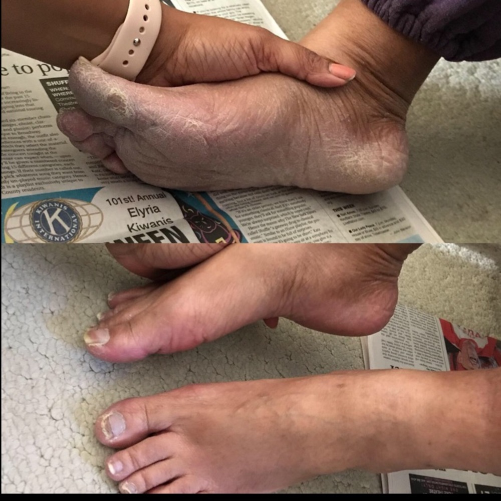 Electric Foot Callus Remover Rechargeable - Picture 4 of 6